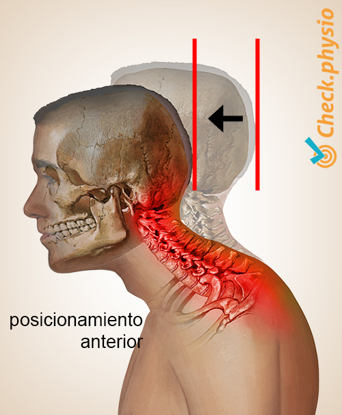 cabeza síndrome de postura cervical del cuello anteroposición de la cabeza adelantada