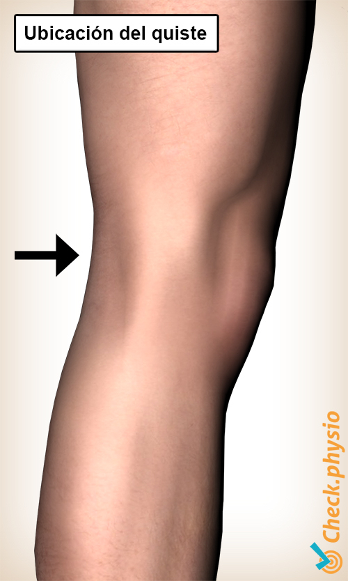 rodilla ubicación del quiste de baker fosa de la parte posterior de la rodilla