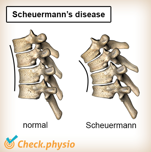 espalda enfermedad de Scheuermann postura de columna columna vertebral normal cifosis convexa anatomía en forma de cuña